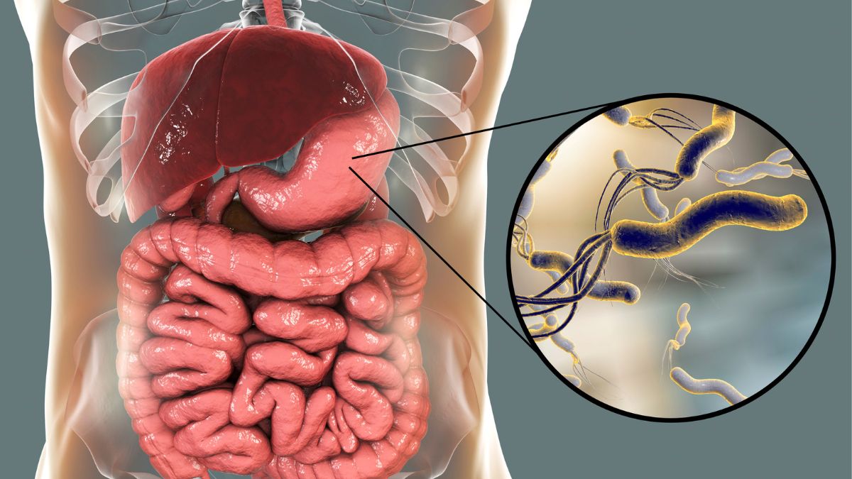 Helicobacter pylori: una causa modificable del cáncer gástrico